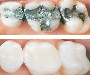 Link to more info about Tooth-Colored Fillings