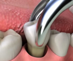 Link to more info about Tooth Extractions