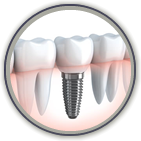 Dental Implants McDonough