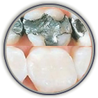 Link to more info about White Fillings