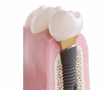 Choosing a Professional for Your Dental Implants in McDonough