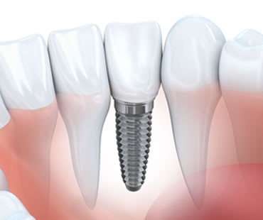 Dental Implants: A Reason to Smile