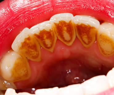 Gum Disease More Prevalent than Originally Suspected