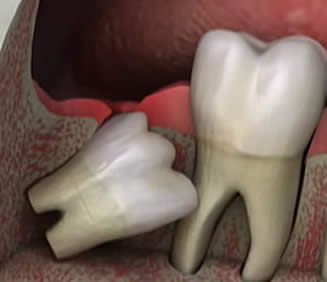 Wisdom Teeth: Should They Stay or Should They Go?