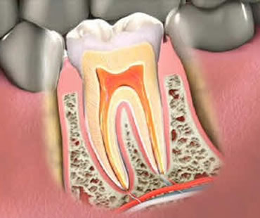 Should an Endodontist Perform Your Root Canal Treatment?