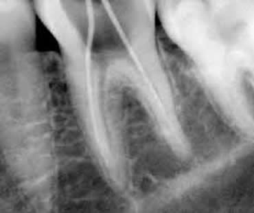 Why Do I Need Root Canal Treatment?