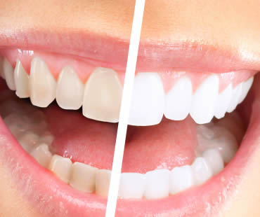 Teeth Whitening: Get the Facts