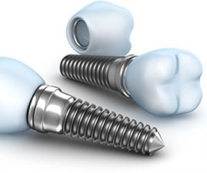 Dental Implants: Choosing the Best Implant Dentist