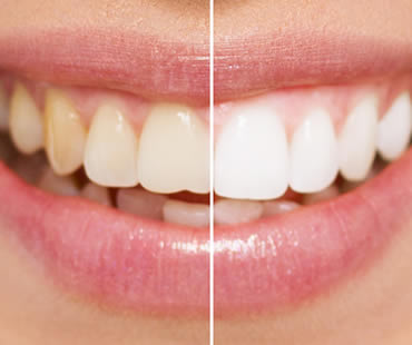 Boost Your Teeth Whitening Results