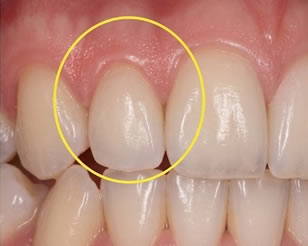 Gum Disease Treatment