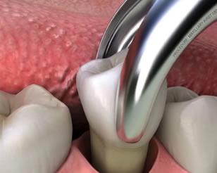 Tooth Extractions