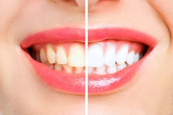 Perfecting your Pearly Whites: How Cosmetic Dentistry Can Transform Your Smile